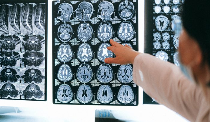 brain injury and bladder